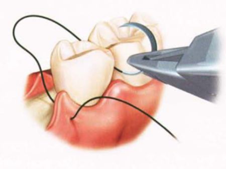 Picture for category Sutures & Accessories (Dental)